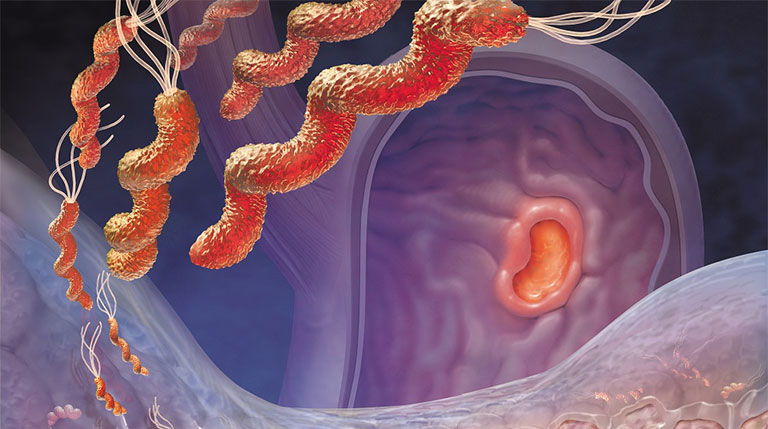 Nhiễm khuẩn HP trong dạ dày có nguy hiểm không?
